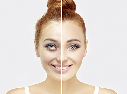 Akne-Gesichtsbehandlung-für-Damen-und-Herren