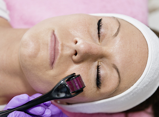 Gesichtsbehandlung-Behandlung-mit-dem-Dermaroller-Mesoneedling