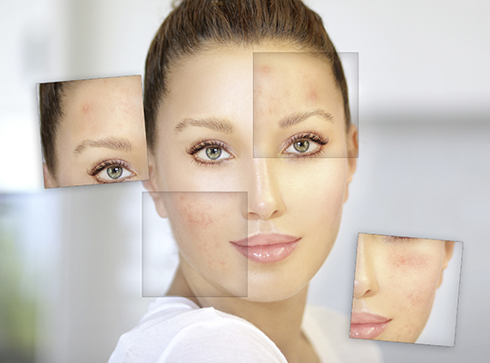 Gesichtsbehandlung-Rosacea-Behandlung